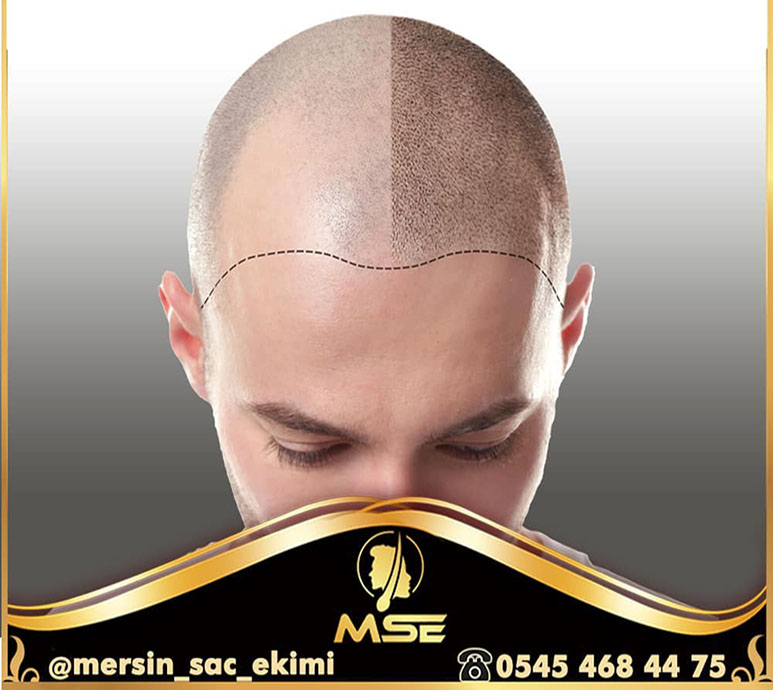 SAÇ EKİMİ NEDİR?